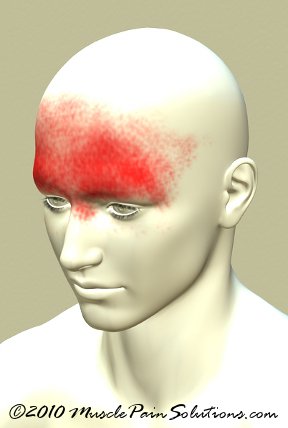 Frontal headache