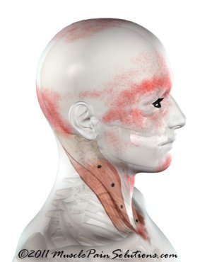 Sternocleidomastoid muscle - sternal branch