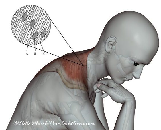 Myofascial Trigger Points