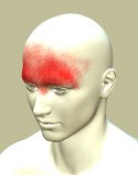 Frontal headache