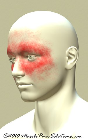 Chronic Sinus Headaches