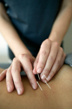 Dry needling