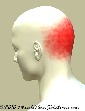 Occipital headache