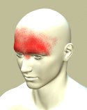 Frontal Headache