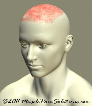 Headache on Top of Head