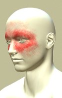 What causes headache-Sinus Headache